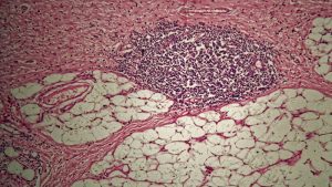 Cellule del tumore allo stomaco