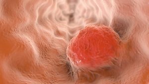 Cancro all'esofago: nel microbioma orale i batteri che aumentano il rischio