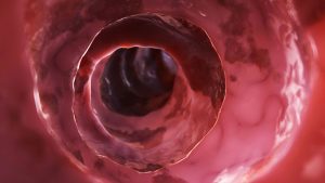 Intestino malato - Morbo di Crohn: analisi del microbioma utile per pianificare la terapia