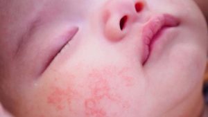 Bambino neonato con dermatite atopica sulla guancia