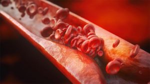 Closeup rendering HD di aterosclerosi a causa di colesterolo HDL