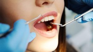 Close up bocca carie dentale microbioma orale