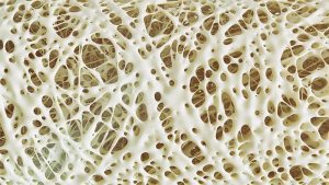Osteoporosi in stato avanzato rendering 3D