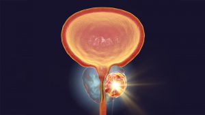Tumore alla prostata in sviluppo correlato al microbiota