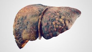 Fegato con cirrosi epatica: scoperte differenze nel microbiota