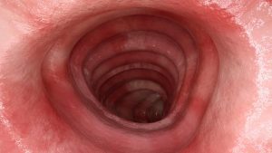 Colite ulcerosa: il microbiota influenza le IBD