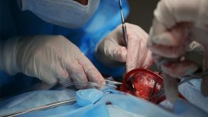 Chirurgo esegue trapianto di cuore: il microbiota intestinale influenza l'esito e il rigetto