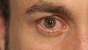 Cheratite: infiammazione oculare e microbiota