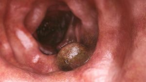 Simbiontici e cancro al colon