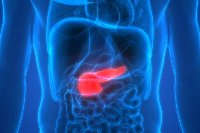 Tumore al pancreas: individuata correlazione con microbioma della lingua Tumore al pancreas: individuata correlazione con microbioma della lingua