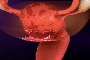 Endometriosi: primi indizi sul ruolo del microbioma intestinale e genitale