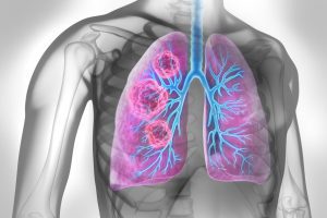 Batteri presenti nei polmoni potrebbero favorire l’insorgenza del tumore