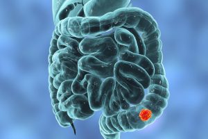 Studio su Science: proteina prodotta da E. coli coinvolta nel tumore del colon-retto