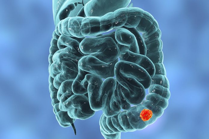 Studio su Science: proteina prodotta da E. coli coinvolta nel tumore del colon-retto Studio su Science: proteina prodotta da E. coli coinvolta nel tumore del colon-retto
