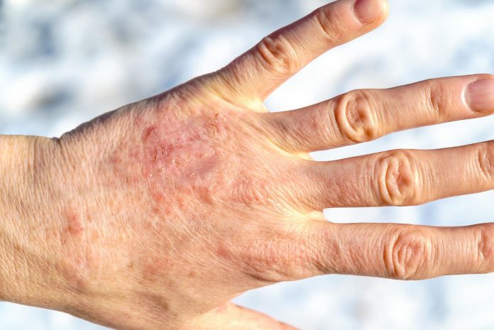 Psoriasi: ulteriori conferme sul ruolo del microbiota intestinale e cutaneo Psoriasi: ulteriori conferme sul ruolo del microbiota intestinale e cutaneo
