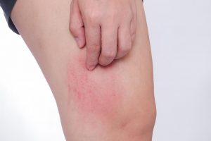 Eczema: studio USA chiama in causa l'equilibrio tra diversi ceppi di Staphylococcus