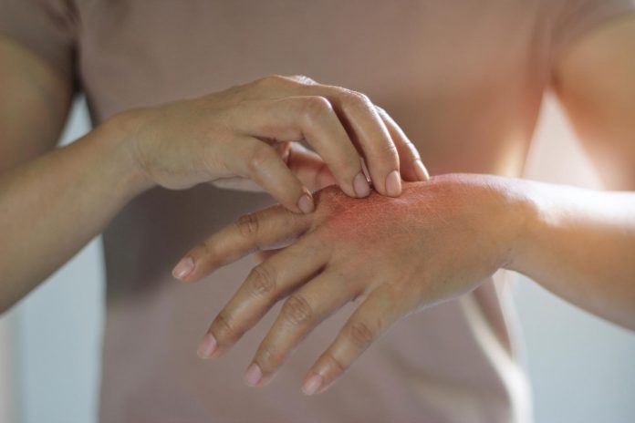 Infezioni cutanee: vitamina A fondamentale per la protezione della pelle Infezioni cutanee: vitamina A fondamentale per la protezione della pelle