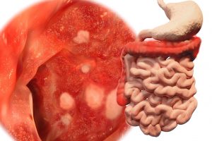 Colite ulcerosa e trapianto di microbiota in condizioni anaerobie: quali vantaggi?
