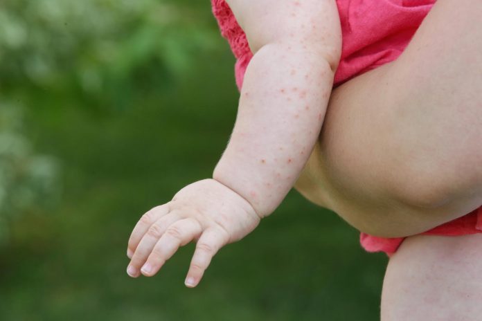 Allergie alimentari e microbiota intestinale: lo stato dell’arte della ricerca Allergie alimentari e microbiota intestinale: lo stato dell’arte della ricerca