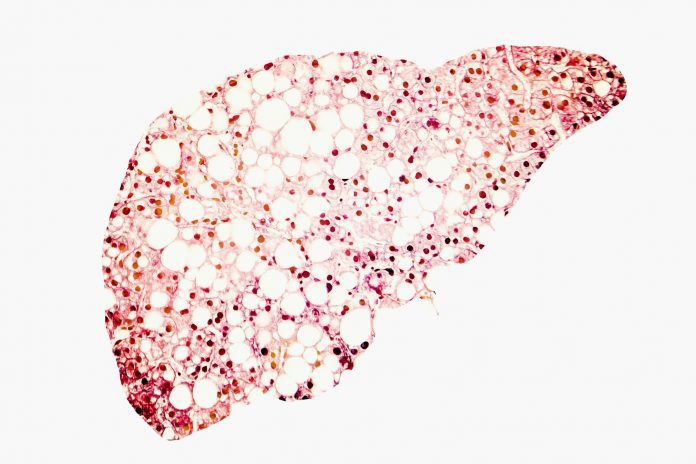 Steatosi epatica non alcolica: microbioma indicatore prognostico della cirrosi Steatosi epatica non alcolica: microbioma indicatore prognostico della cirrosi