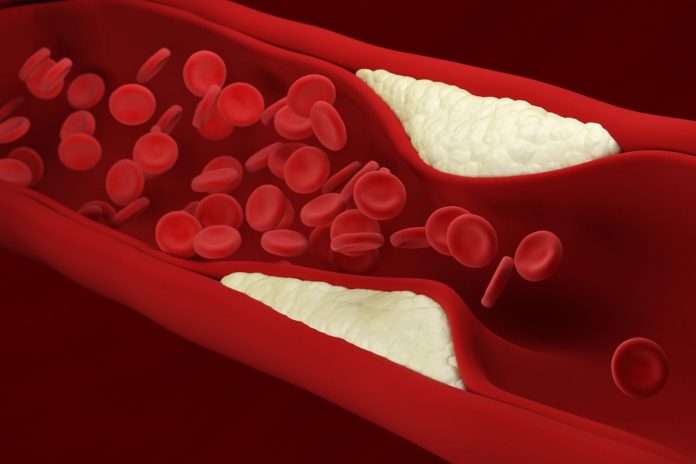 Lactobacillus plantarum ZDY04 nella prevenzione e cura dell’aterosclerosi Lactobacillus plantarum ZDY04 nella prevenzione e cura dell’aterosclerosi