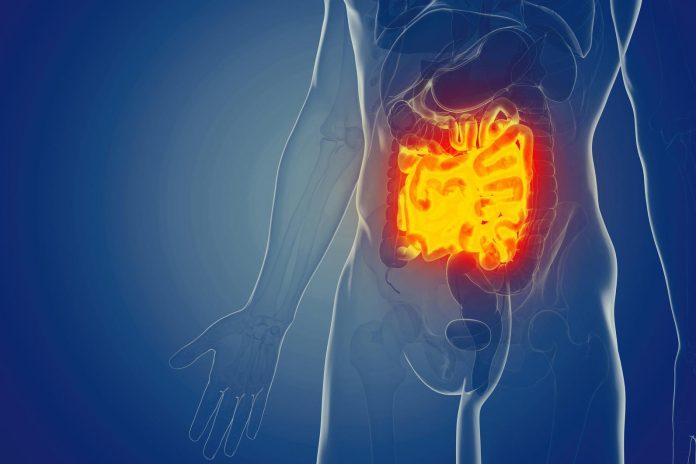 Studio rivela in che modo le IBD modificano il microbiota intestinale Studio rivela in che modo le IBD modificano il microbiota intestinale