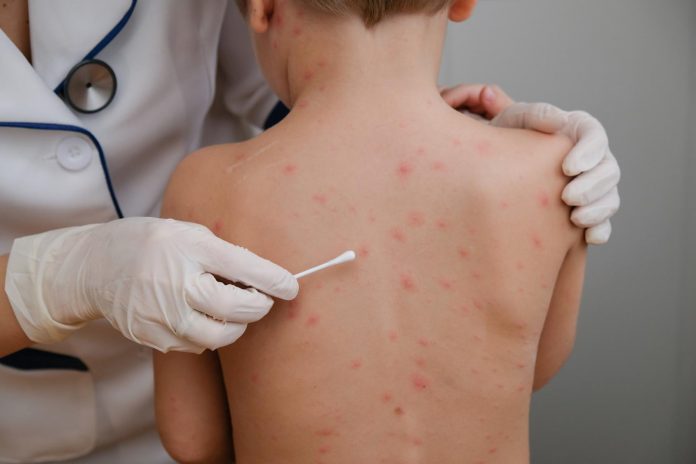 Studio UK svela connessione tra Staphylococcus aureus e allergie alimentari Studio UK svela connessione tra Staphylococcus aureus e allergie alimentari