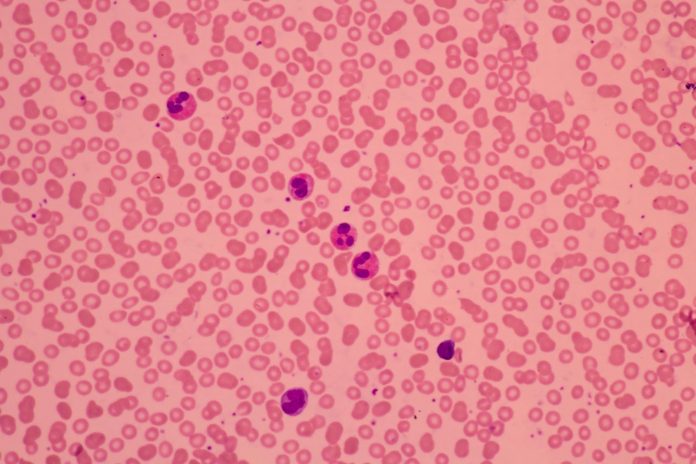 Leucemie infantili: resistoma intestinale coinvolto nel rigetto da trapianto di midollo osseo Leucemie infantili: resistoma intestinale coinvolto nel rigetto da trapianto di midollo osseo
