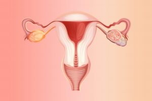 Tumore alle ovaie: disbiosi del microbioma vaginale possibile fattore di rischio