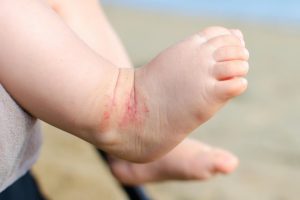 Eczema infantile: possibile diagnosi precoce analizzando il microbiota cutaneo