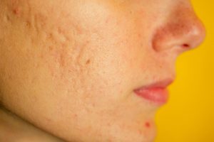 L'acne può essere causata da un intervallo nel dialogo pelle-microbiota