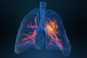 Yogurt e fibre riducono il rischio di tumore polmonare, lo rivela studio su JAMA Oncology