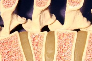 Trapianto di midollo: individuato batterio intestinale che “scatena” il rigetto