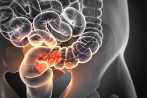 Tumore al colon: ricercatori italiani individuano batteri intestinali che lo prevengono