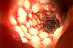 Specifici lipidi che modificano il microbiota intestinale correlati alle IBD