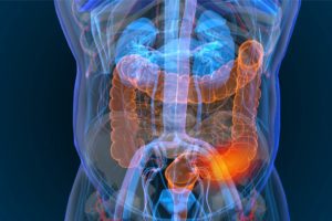 Studio Nature: scoperto specifico batterio intestinale associato al tumore del colon