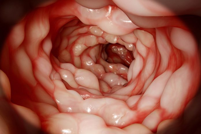 Diverticolite acuta non complicata: mix di probiotici riduce dolore e infiammazione Diverticolite acuta non complicata: mix di probiotici riduce dolore e infiammazione