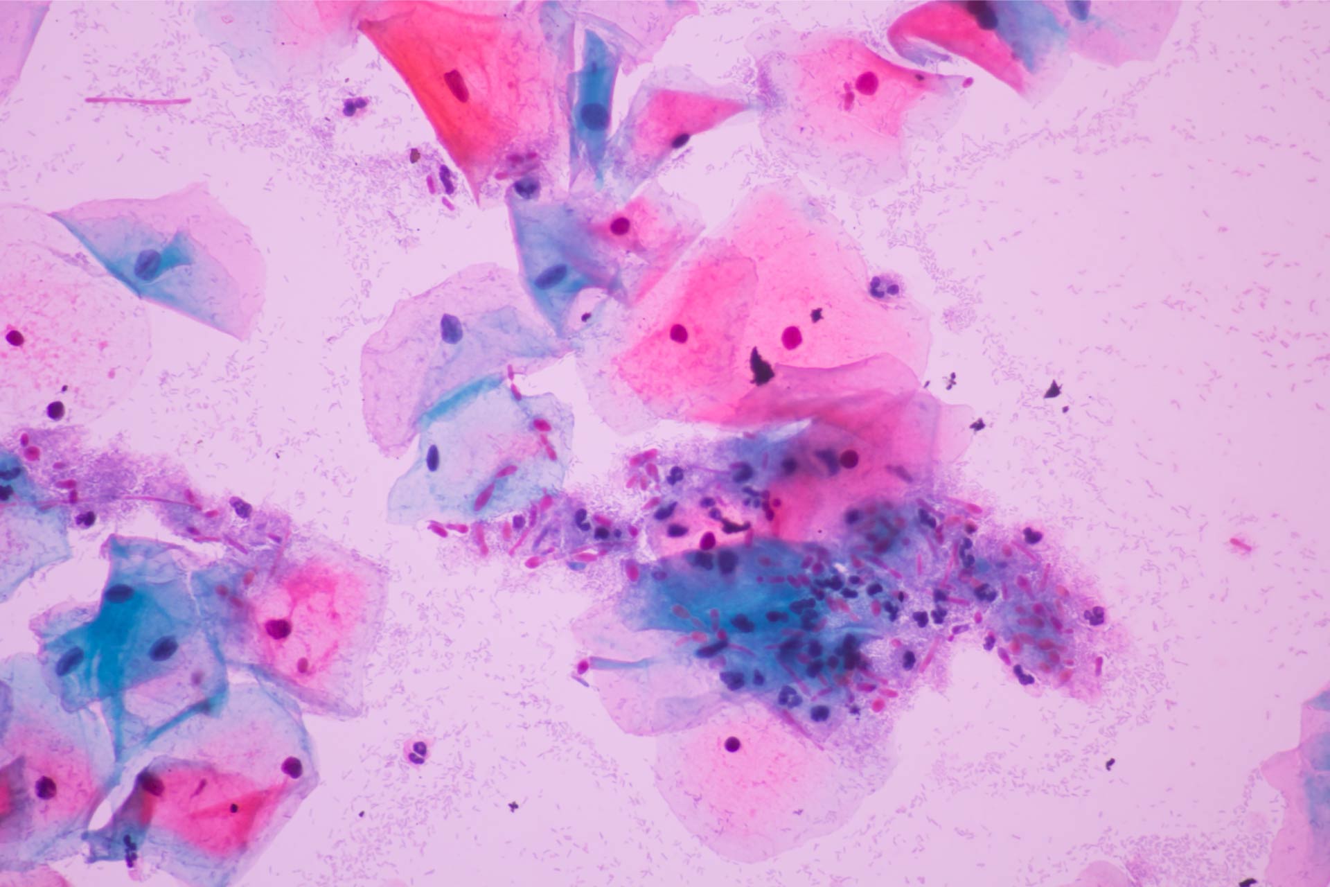 Lactobacillus gasseri associato a vestibolodinia. Il ginecologo Murina: «Riequilibrare l’assetto lattobacillare vaginale»