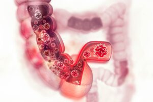 Tumore al colon ereditario: il ruolo del microbiota intestinale nella sindrome di Lynch