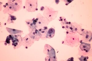Papillomavirus: individuato batterio vaginale potenziale biomarker per la progressione tumorale
