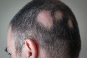 Alopecia areata: studio italiano rivela ruolo del microbiota cutaneo e intestinale